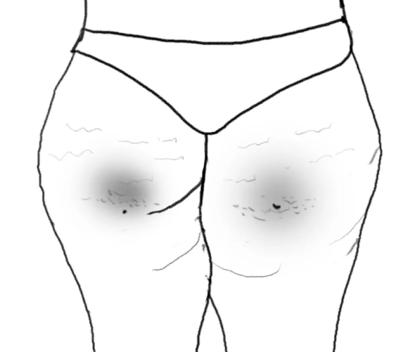 Hai vết sạm đen hình thành do ngồi lâu. Giữ tư thế ngồi trong thời gian dài, điểm chịu lực lớn nhất là mông. Da khu vực này đồng thời cũng là bề mặt nâng đỡ cơ thể. Chịu sức nén giữa cơ thể với ghế, melanin có xu hướng lắng đọng cục bộ ở khu vực này.