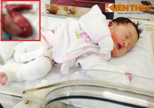 Benh EB: Neu tre nhiem trung nguy co tu vong rat cao