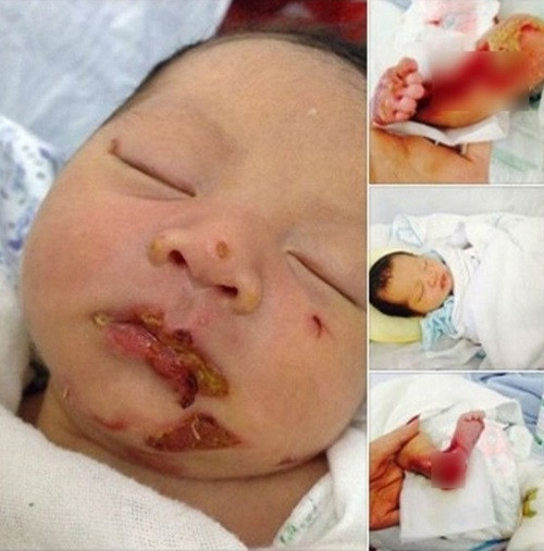 Hình ảnh bé Vũ bị bỏ rơi và lở loét khắp người trước đó khiến ai nấy cũng xót xa, tội nghiệp.