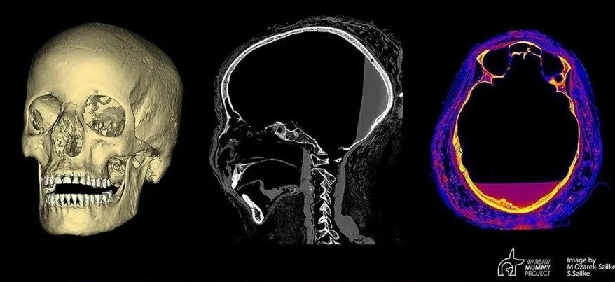 Trong nghiên cứu thứ hai, nhóm nghiên cứu đề xuất rằng lý do không thể xác định rõ ràng xương thai nhi là do tử cung của người mẹ thiếu oxy và trở nên có tính axit theo thời gian, về cơ bản là "làm chua" thai nhi. Về sau, nhóm nghiên cứu cho rằng đã tìm thấy bằng chứng về ung thư vòm họng có khả năng gây ra cái chết của bà nghi nghiên cứu hộp sọ. Ảnh: thearchaeologist.