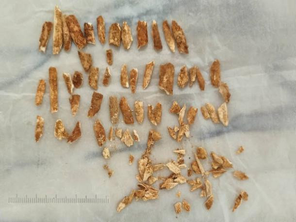Thi hài "đứa trẻ Lapedo" có một số đặc điểm nổi bật bao gồm: cằm nhô ra giống như người Homo sapiens nhưng chân ngắn và chắc nịch giống như loài người cổ Neanderthal. Ảnh: João Zilhão/Science Advances.