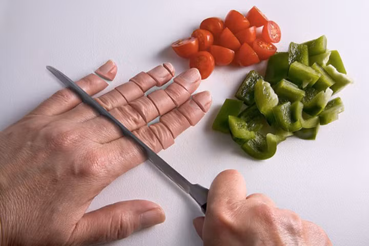 Hội chứng Autophagia: Có thể bạn không tin, nhưng có những người thèm muốn ăn thịt của chính bản thân. Họ cắn, nhai những bộ phận cơ thể chính mình một cách điên loạn, bắt đầu từ móng tay đến ngón tay và các bộ phận khác. Autophagia được xem là một trong những hội chứng rối loạn tâm lý nguy hiểm bậc nhất thế giới. Không ít người mắc phải autophagia có nhiều hành vi xâm hại tính mạng của người khác và chính bản thân mình.