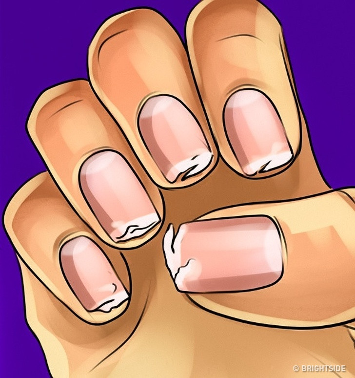 Móng dễ gãy: Giống như xương của bạn, móng tay của bạn cũng cần một lượng canxi nhất định. Vì vậy, khi bạn bị thiếu canxi, móng tay sẽ bị khô giòn yếu và dễ gãy hơn.