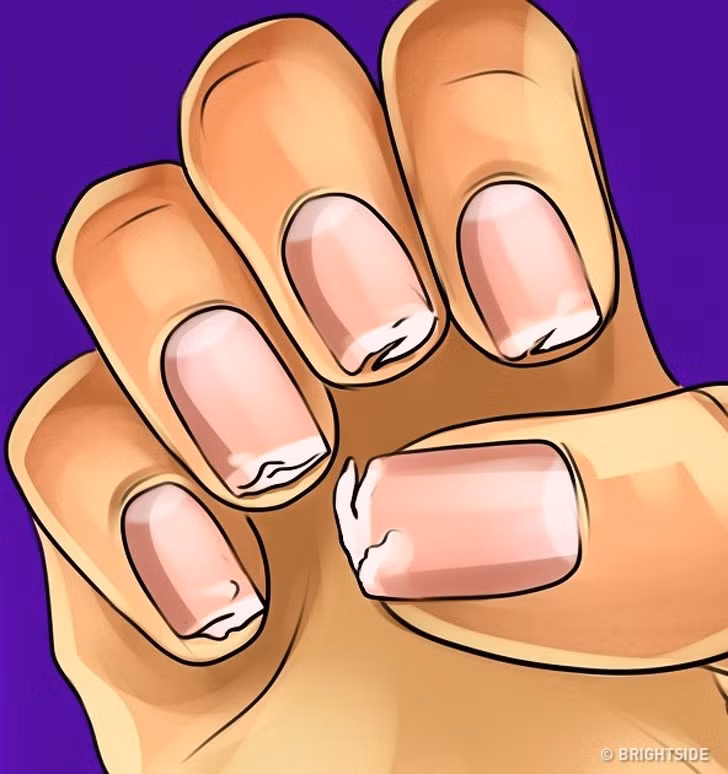 Móng dễ gãy: Giống như xương của bạn, móng tay của bạn cũng cần một lượng canxi nhất định. Vì vậy, khi bạn bị thiếu canxi, móng tay sẽ bị khô giòn yếu và dễ gãy hơn.