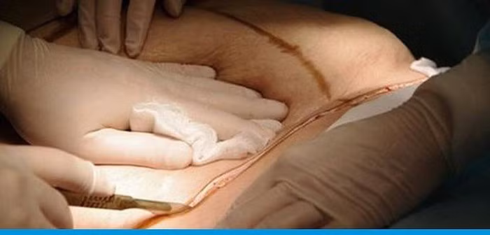 Ram ro trao luu ket hop boc mo giam beo khi mo de, thuc hu tac dung?