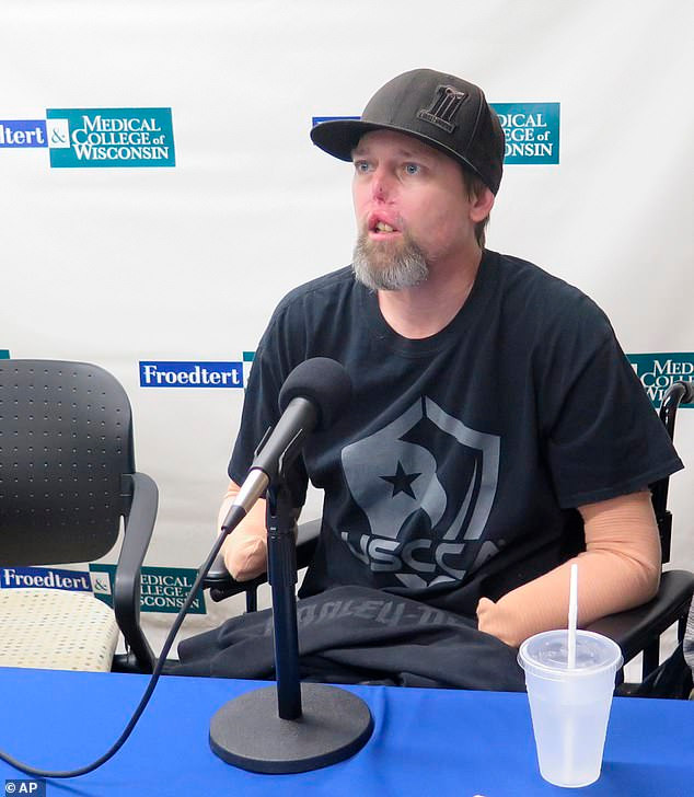 Greg Manteufel, 48 tuổi, ở Mỹ, vừa trải qua 7 cuộc đại phẫu kể từ nhập viện từ cuối tháng 6 với các triệu chứng tương tự như cúm gồm sốt, nôn mửa và tiêu chảy. Greg được đưa đến phòng cấp cứu khi các vết bầm tím xuất hiện trên tay và chân.