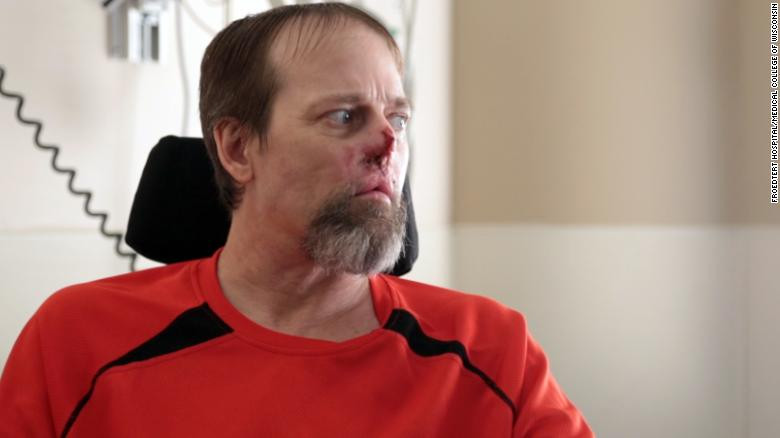 Các biểu hiện này xuất hiện trong vòng 3-5 ngày song đôi lúc thời gian ủ bệnh lên tới hai tuần. Một số bệnh nhân tử vong sau 72 giờ nhiễm vi khuẩn.