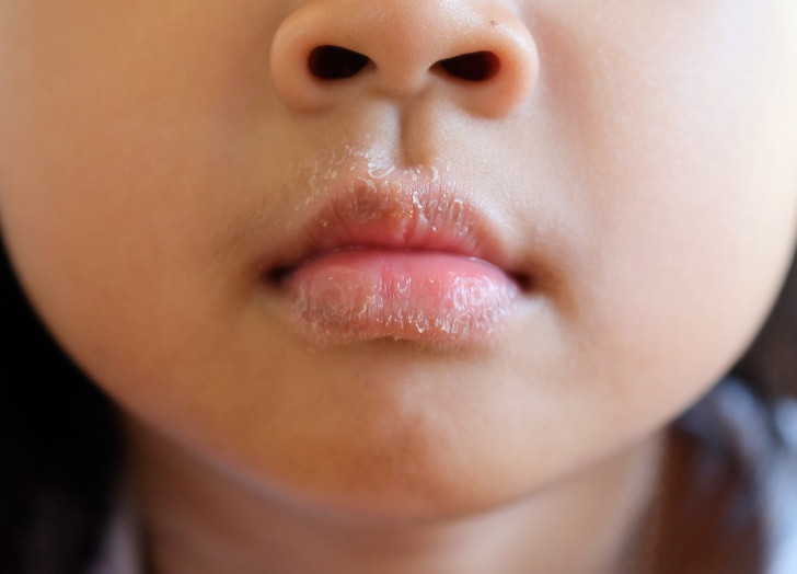 Môi khô hoặc nứt: Ngoài lý do quá lạnh, môi khô nứt là một thay đổi cơ thể cảnh báo dị ứng. Trong trường hợp này, hãy chú ý đến mỹ phẩm mà bạn sử dụng, cũng như các sản phẩm vệ sinh răng miệng, thực phẩm bạn ăn và thậm chí cả thuốc men. Các vết nứt ở các góc miệng cho thấy cơ thể thiếu vitamin B, A và E.