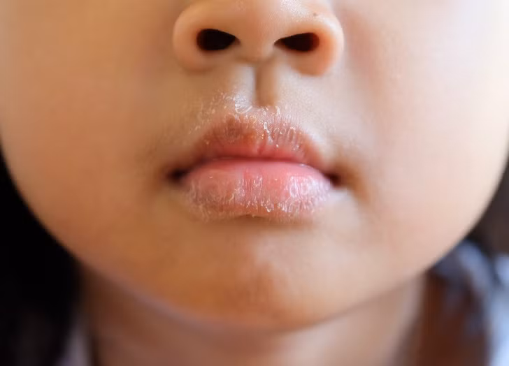 Môi khô hoặc nứt: Ngoài lý do quá lạnh, môi khô nứt là một thay đổi cơ thể cảnh báo dị ứng. Trong trường hợp này, hãy chú ý đến mỹ phẩm mà bạn sử dụng, cũng như các sản phẩm vệ sinh răng miệng, thực phẩm bạn ăn và thậm chí cả thuốc men. Các vết nứt ở các góc miệng cho thấy cơ thể thiếu vitamin B, A và E.