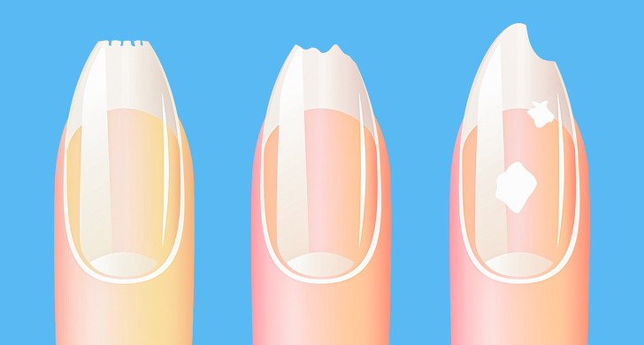 Móng tay mỏng, nhạt màu: Móng tay mỏng và nhợt nhạt có thể là dấu hiệu thiếu máu và thiếu sắt trong cơ thể, trong khi móng vàng có thể biểu hiện các rối loạn về gan và dạ dày hoặc nhiễm nấm. Các đốm trắng và sọc trên móng cho thấy cơ thể thiếu kẽm, đồng và iốt.