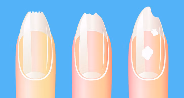 Móng tay mỏng, nhạt màu: Móng tay mỏng và nhợt nhạt có thể là dấu hiệu thiếu máu và thiếu sắt trong cơ thể, trong khi móng vàng có thể biểu hiện các rối loạn về gan và dạ dày hoặc nhiễm nấm. Các đốm trắng và sọc trên móng cho thấy cơ thể thiếu kẽm, đồng và iốt.