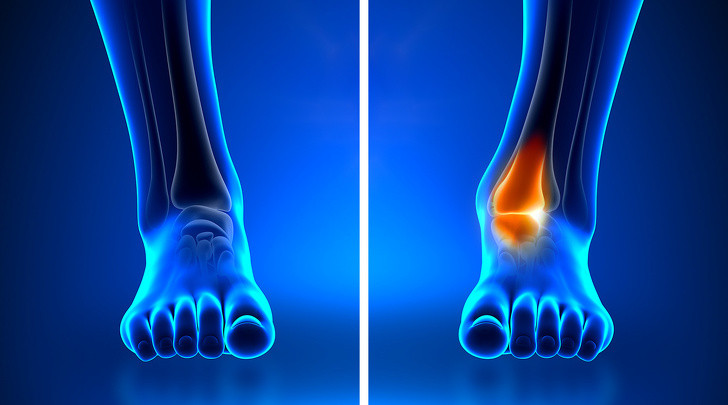 Ngón chân sưng: Ngay cả khi bạn có làn da trắng, mịn màng, không bị kích ứng, không ngứa, nhưng ngón chân của bạn giống như sưng phù lên thì bạn nên đi khám bác sĩ. Triệu chứng này có thể báo hiệu bệnh viêm khớp, vảy nến.
