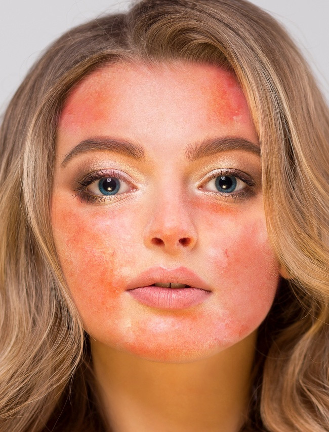 Chanh gây bỏng da: Nhiều phụ nữ thường sử dụng chanh để loại bỏ các đốm đen, sắc tố, tàn nhang và mụn trứng cá. Tuy nhiên, các loại dầu trong quả chanh thường chứa phototoxic, chất độc có thể gây ra bỏng nếu tiếp xúc dưới ánh mặt trời ngay sau khi sử dụng.