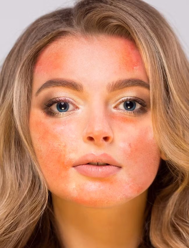 Chanh gây bỏng da: Nhiều phụ nữ thường sử dụng chanh để loại bỏ các đốm đen, sắc tố, tàn nhang và mụn trứng cá. Tuy nhiên, các loại dầu trong quả chanh thường chứa phototoxic, chất độc có thể gây ra bỏng nếu tiếp xúc dưới ánh mặt trời ngay sau khi sử dụng.