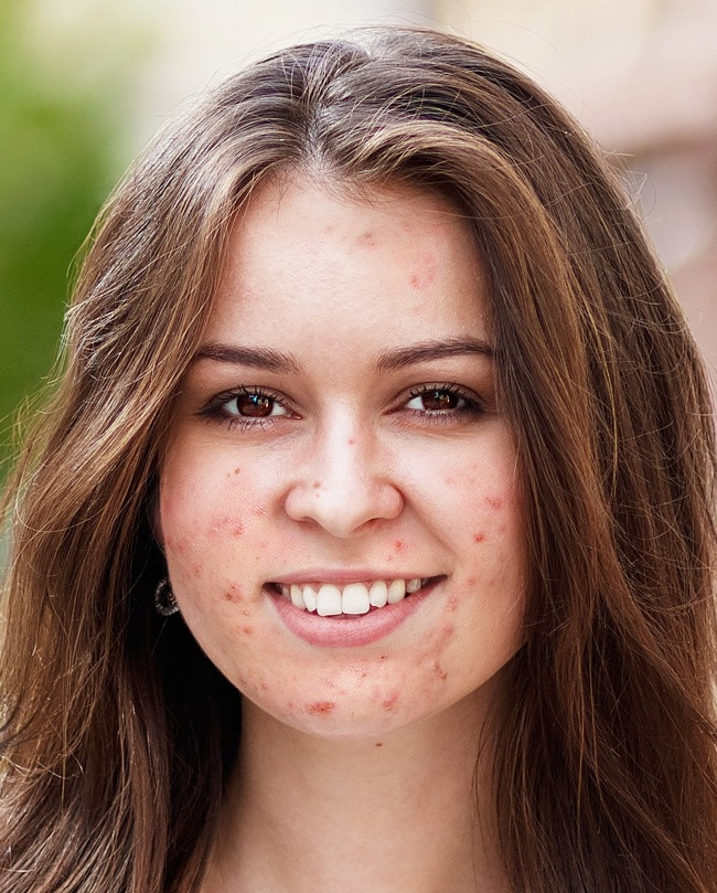 Nước ấm gây lây lan mụn trứng cá: Nước ấm gây khô da, làm hỏng hàng rào bảo vệ tự nhiên, bạn có thể nhận thấy những đốm đỏ trên da sau khi tắm quá lâu. Thậm chí, nó còn làm lây lan mụn trứng cá.