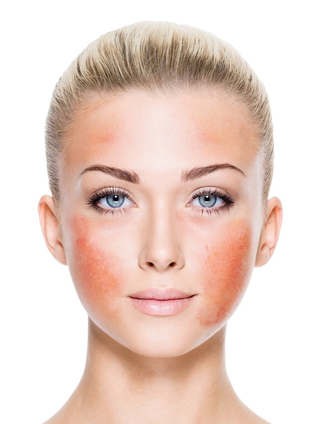 Kem đánh răng làm bỏng da: Các chuyên gia khuyến cáo rằng, bạn không được thoa kem đánh răng trên da mụn và các đốm đỏ. Kem đánh răng có chứa các thành phần như bạc hà, peroxide, hương liệu nhân tạo và rượu, những chất có thể gây bỏng da.