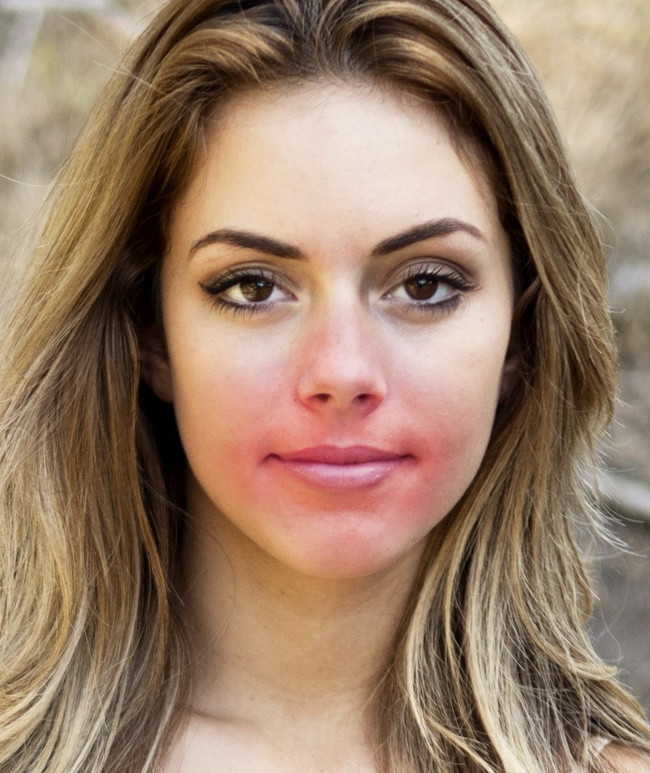 Peroxide gây kích ứng và đỏ: Peroxide là một chất sát trùng tốt để điều trị những vết trầy xước, vết thương và vết cắt. Tuy nhiên, peroxide thường gây kích ứng và mẩn đỏ. Hơn nữa, nếu sử dụng quá thường xuyên, peroxide sẽ làm hỏng các chức năng bảo vệ da và ảnh hưởng đến độ ẩm tự nhiên.