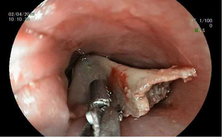 Nhung truong hop hoc di vat khi an gay tu vong thuong tam-Hinh-4