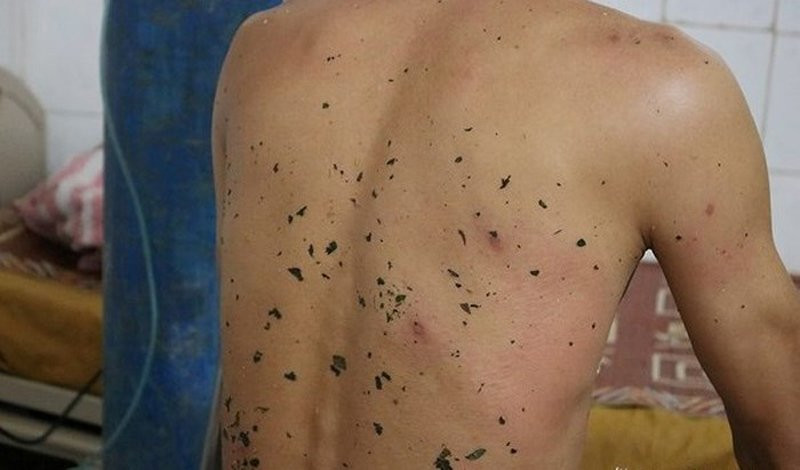 Nhung truong hop ong dot chet nguoi thuong tam