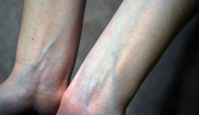 Gân xanh ở cổ tay: Đây là dấu hiệu cho thấy bạn có nguy cơ mắc phải bệnh xơ cứng động mạch vành, nếu chủ quan bỏ qua mà không điều trị sớm thì còn dẫn đến các bệnh về tim mạch về sau.