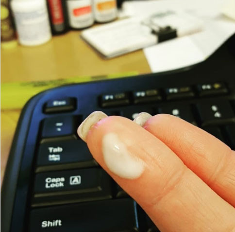 Keo PVA (keo sữa): Loại keo này có thể giúp bạn loại bỏ mảnh dằm sâu trong da. Thoa một ít keo PVA lên vùng bị dằm và để khô. Sau đó, bóc bỏ lớp keo khô để kéo cả dằm ra ngoài.