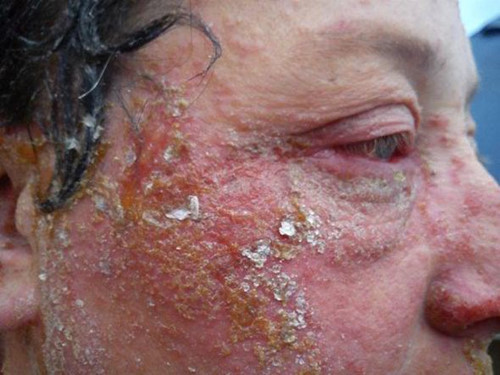 Theo chia sẻ của cô Jo Thomson sống tại Margate, Kent, Anh, người cũng dị ứng với thuốc nhuộm tóc thì: "Sau khi nhuộm thuốc nhuộm tóc lên đầu, tôi cảm giác như có ai đó đổ xăng lên đầu và thắp lửa như ngọn đuốc cháy bùng trên đầu, thật kinh hoàng".