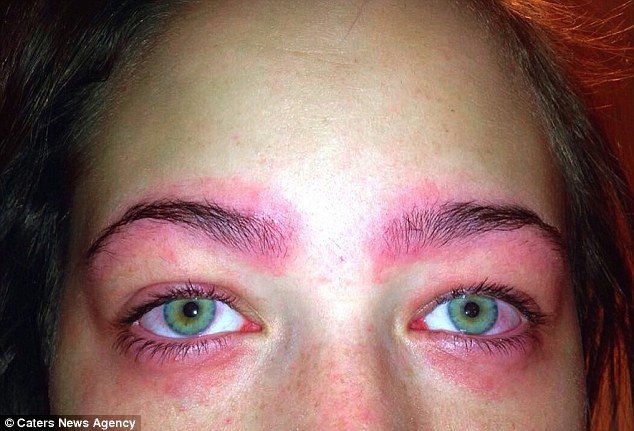 Tylah đã nhập viện trong tình trạng nguy kịch và hoảng sợ, các bác sĩ nói rằng nếu không được xử lý nhanh thì nữ sinh này có thể bị mù.