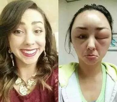 Thuốc nhuộm tóc thường gây mẫn cảm chéo nên nhiều người từng bị dị ứng với loại thuốc nhuộm này khi đổi sang loại khác vẫn bị. Đây là loại dị ứng muộn.