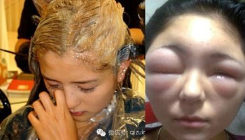 Trên thực tế, các bệnh viện thường xuyên tiếp nhận những trường hợp bị viêm da tiếp xúc do dị ứng với thuốc nhuộm tóc. Tỷ lệ bệnh nhân dị ứng thuốc nhuộm tóc rất cao, gấp nhiều lần so với tiếp xúc với các loại hóa mỹ phẩm khác. 