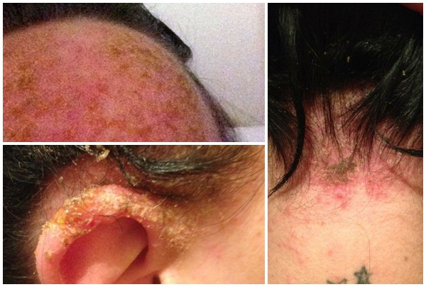 Năm ngoái, cô gái tên Gemma Williams (24 tuổi, người Anh) đã bị nhiễm trùng máu sau khi bôi thuốc nhuộm đen lên tóc. Các bác sĩ tại bệnh viện Manchester Royal (Anh) nói với Williams rằng, nếu cô đến bệnh viện chỉ chậm một giờ sẽ chết vì nhiễm độc.