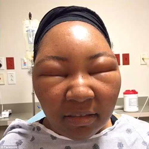 Theo Daily Mail, Chemese Armstrong (35 tuổi), một vlogger thể dục tại Texas (Mỹ), cũng từng bị biến dạng khuôn mặt vì dị ứng thuốc nhuộm tóc.