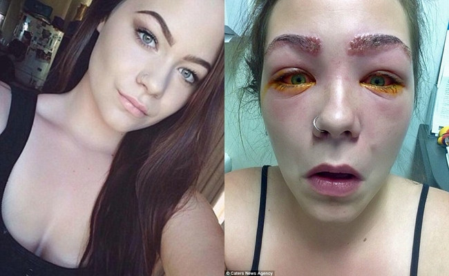 Năm ngoái, nữ sinh trung học 16 tuổi Tylah Durie, ở bang Victoria, Australia, cũng phải nhập viện khi mắt cô gần như mù do dị ứng với thuốc nhuộm tóc.