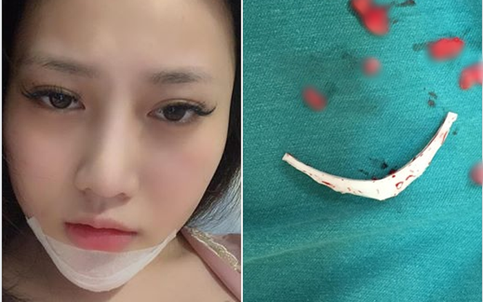 Kinh hoang bien chung phau thuat tham my dang so nam 2018