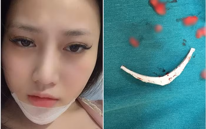 Kinh hoàng biến chứng phẫu thuật thẩm mỹ đáng sợ năm 2018 Kinh hoang bien chung phau thuat tham my dang so nam 2018