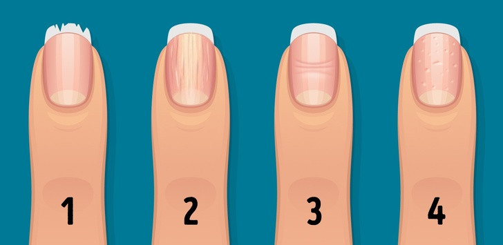 Thay doi mong tay canh bao tinh trang suc khoe nghiem trong-Hinh-2