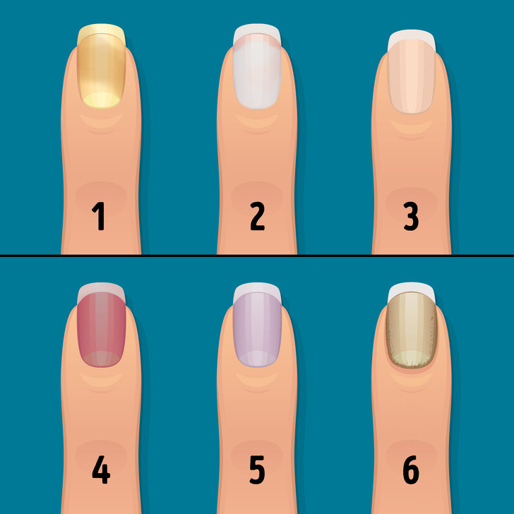 Thay doi mong tay canh bao tinh trang suc khoe nghiem trong