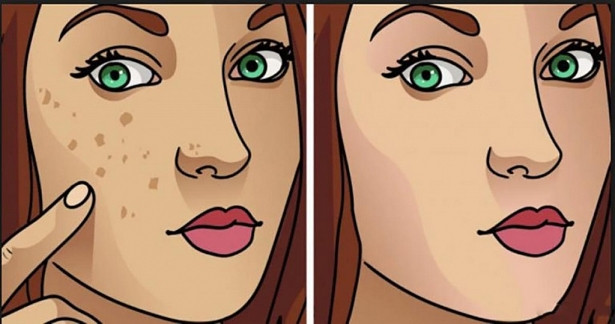 Cac nguyen lieu tu nhien giup xoa tan nhang, vet tham nam tren da