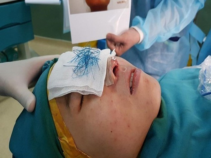 Ngày 17/1/2018, TS-BS Nguyễn Phan Tú Dung, Giám đốc Bệnh viện (BV) Thẩm mỹ JW Hàn Quốc TP HCM, họ đã cứu thành công bệnh nhân bị hoại tử mũi nặng do nâng mũi bằng chỉ khâu da.