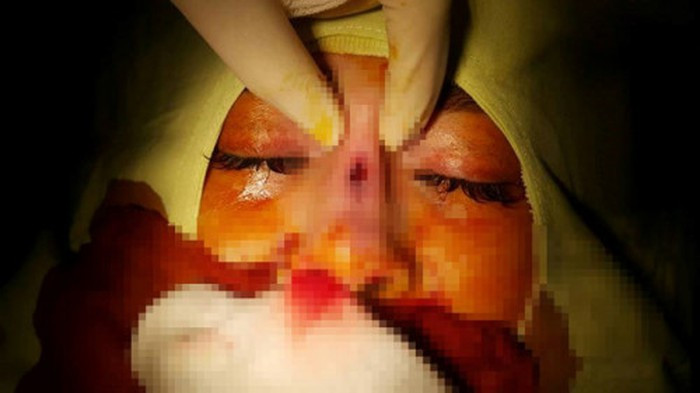 Cuối tháng 2/2018, cô gái trẻ 29 tuổi (ngụ tại TP.HCM) đã đến một spa theo lời giới thiệu của bạn bè để làm thủ thuật nâng mũi. Cô gái đã thực hiện phẫu thuật nâng mũi bọc sụn với giá 10 triệu đồng. Mức giá này rẻ hơn khá nhiều so với các cơ sở thẩm mỹ uy tín khác (17-20 triệu đồng). Ảnh: ĐSPL.