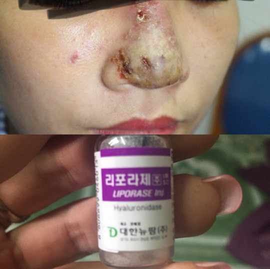 Sau khi tiêm filler nâng mũi tại một cơ sở spa ở quận Đống Đa, Hà Nội, chị Đoàn Thị M. phải nhập viện hồi tháng 6/2018 vì mũi sưng nề tiết dịch, hình thành nhiều ổ mủ trên mũi. Ảnh: NLĐ.