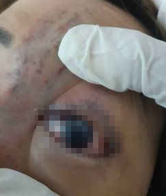 Trước đó không lâu, ngày 17/7, Bệnh viện Trưng Vương kết luận bệnh nhân Nguyễn Thị Dương (30 tuổi, TP.HCM) có nguy cơ mù lòa vĩnh viễn mắt trái vì tắc động mạch do tiêm chất làm đầy để nâng cao sống mũi. Bệnh nhân cho biết trước đó một ngày cô có tiêm chất làm đầy da MISSFILL (Hyaluronic Acide + Lidocaine 2%) vùng sống mũi. Ảnh: Zing.