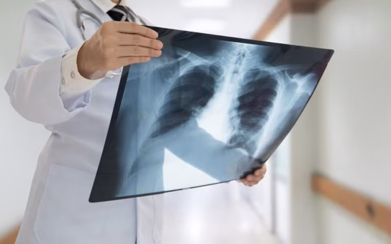 Khó thở hoặc thở khò khè có thể không phải là một triệu chứng nghiêm trọng. Tuy nhiên, nếu bạn đột nhiên khó thở sau khi chạy lên cầu thang trong khi trước đây bạn không bị như vậy thì bạn nên đi khám vì đó có thể là dấu hiệu ung thư phổi.