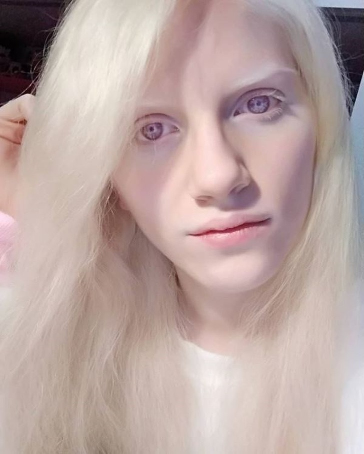 Bệnh bạch tạng có thể khiến con người có đôi mắt màu tím.