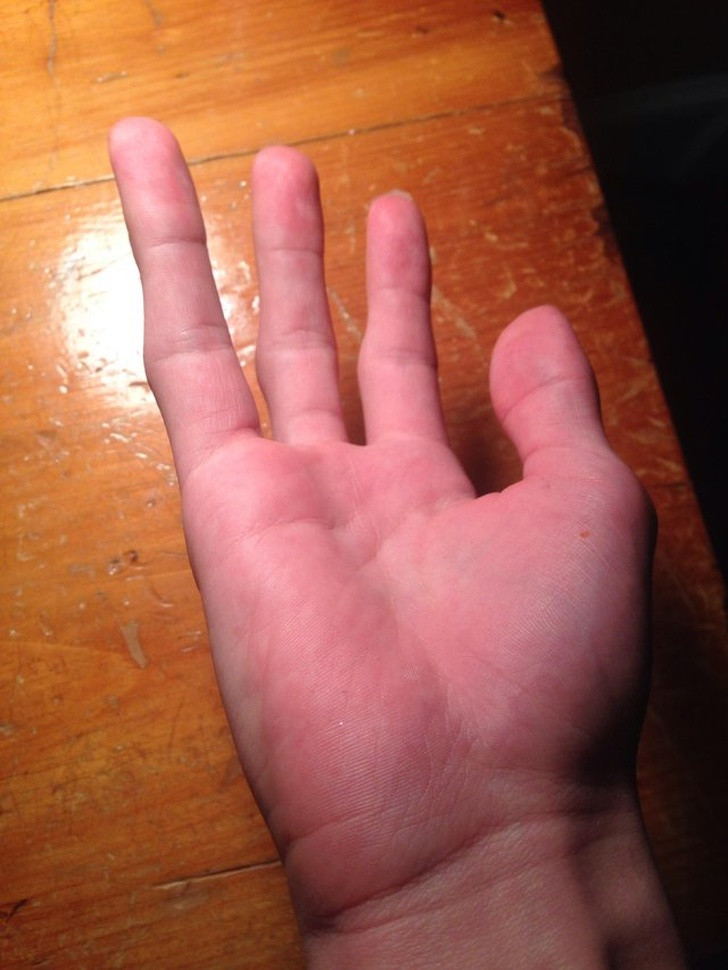 Có người được sinh ra mà không có ngón tay út. Ảnh: BS.