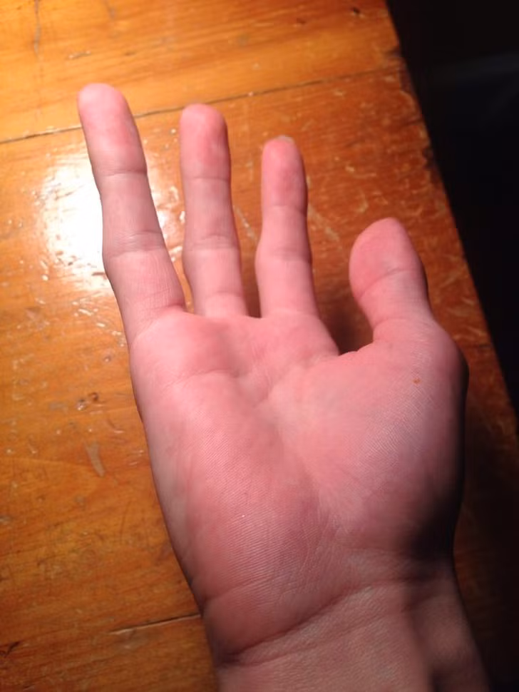Có người được sinh ra mà không có ngón tay út. Ảnh: BS.