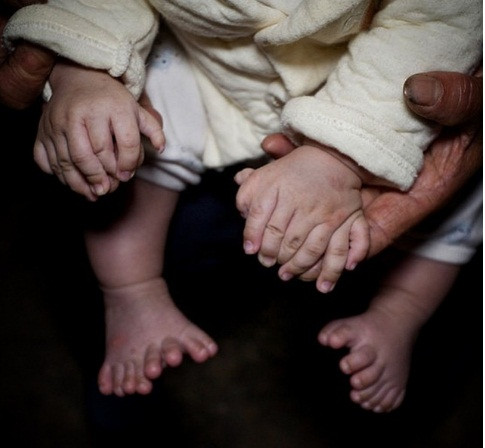 Em bé này có 15 ngón tay và 16 ngón chân.