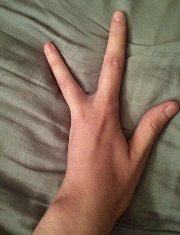 Hội chứng Holt - Oram có thể khiến người ta thiếu xương ở tay và cánh tay. Điều đó khiến cho con người ta trở nên khác biệt với bộ phận cơ thể bất thường.