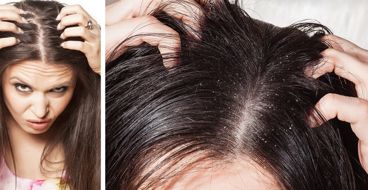 Muối: Tiêu thụ quá nhiều muối dẫn đến mặt phù nề, bọng mắt, gàu và mất nước toàn thân. Tình trạng này khiến cơ thể sản xuất nhiều dầu hơn để chống lại tình trạng thiếu nước. Từ đó, tóc bạn dễ bết và nhờn dính hơn. Do vậy, chúng ta nên hạn chế ăn bánh quy giòn, khoai tây chiên và các thực phẩm nhiều muối khác.