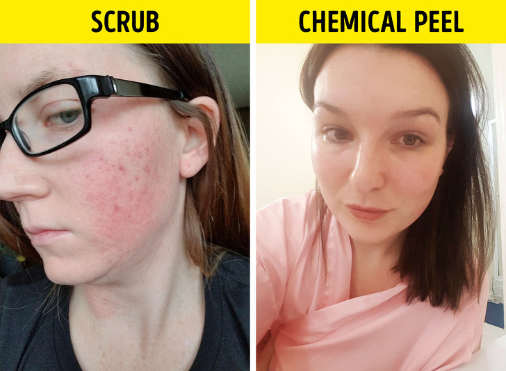 Tẩy tế bào chết hàng ngày cũng là một sai lầm chăm sóc da phổ biến. Tẩy tế bào chết có thể giúp làn da tái tạo nhanh hơn và làm sạch da. Tuy nhiên, nếu bạn tẩy da chết hàng ngày, bạn có nguy cơ tẩy hết cả lớp bảo vệ da.