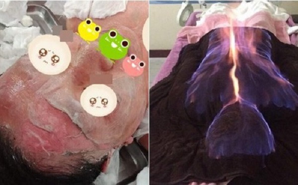 Nguy hiem rinh rap tu hoa lieu phap, dung lua lam dep va chua benh